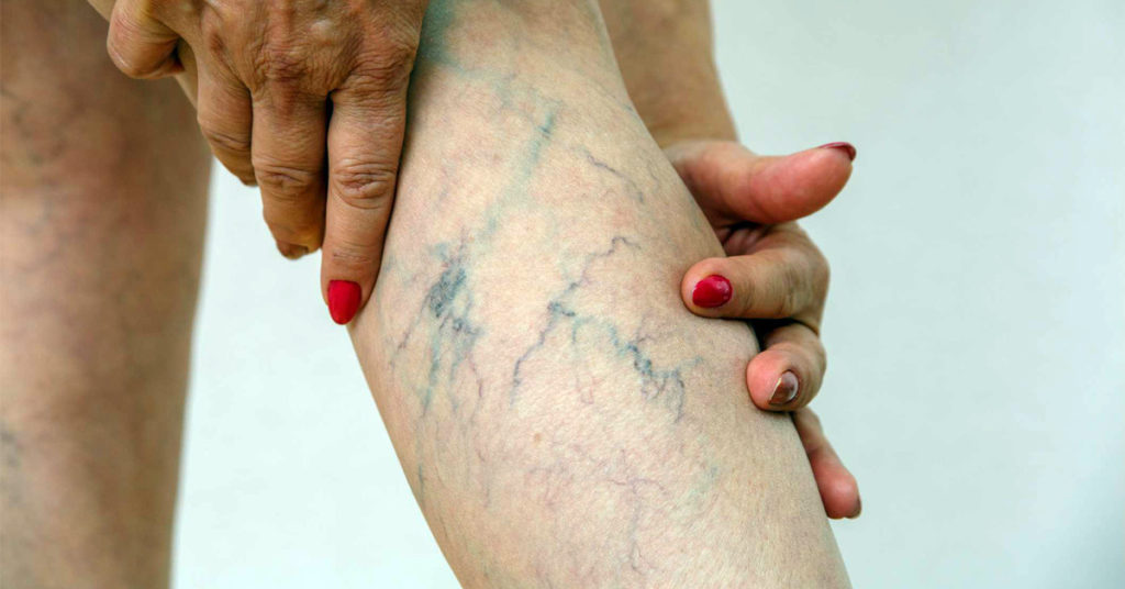 painful varicose veins