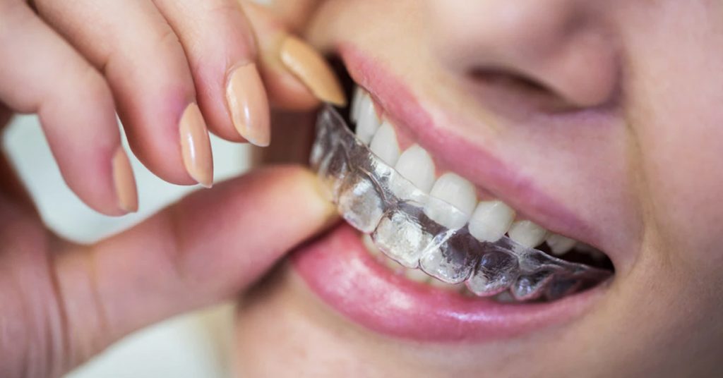 How fix crossbite clear aligners