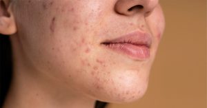 It is significant to get regular check-ups in the early stages. It helps you get instant medication and prevent the severity of an outbreak.