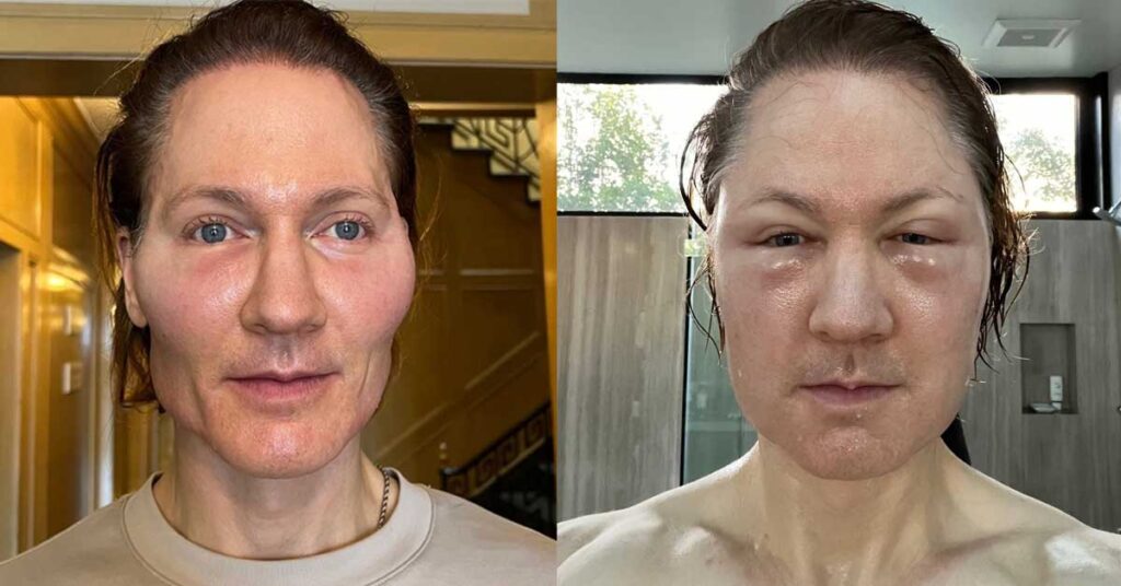 Bryan Johnson revealed the alarming aftermath of his "Project Baby Face" procedure, detailing his drastic transformation in a candid Instagram post.