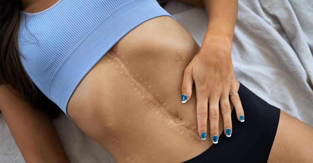 A woman with a surgery scar in the middle of her tummy