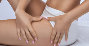 A picture of woman with stretch marks on thigh